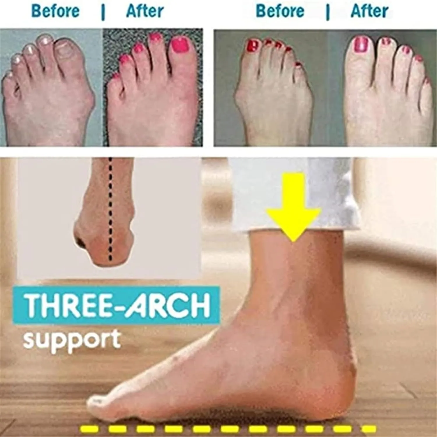 Womens Shoes Sandals with Bunion, Women Summer Bling Rhinestone Strappy Platform Bunion Shoes, Arch Support Flip Flop Sandals for Women, for Orthopedic Big Toe Bone Correction